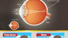 Promoción: Pele el ojo con la miopía 