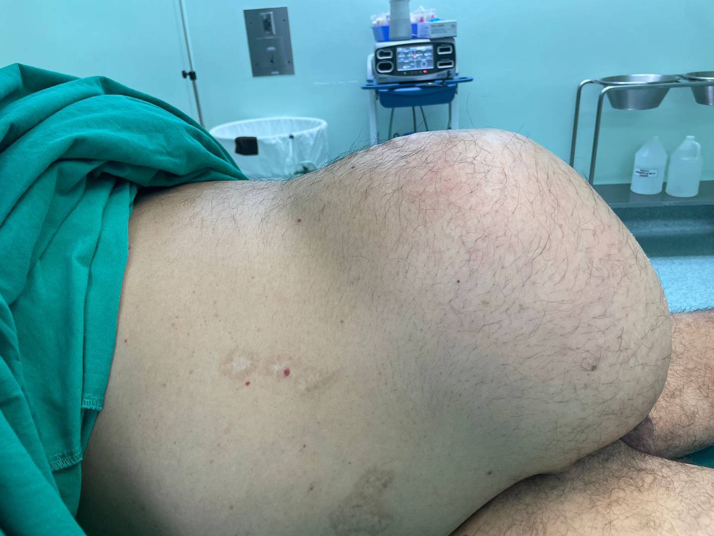 A un paciente de Cañas del hospital Enrique Baltodano Briceño de Liberia le sacaron una hernia tremendamente gigante el pasado viernes 6 e octubre