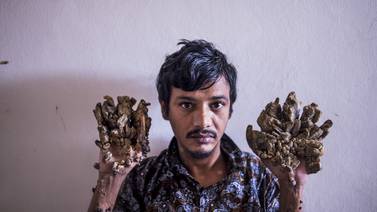 El “hombre-árbol” de Bangladesh, pide que le amputen las manos