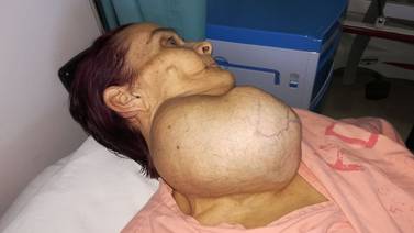 A una abuelita le quitan del cuello un tumor gigante de casi dos kilos