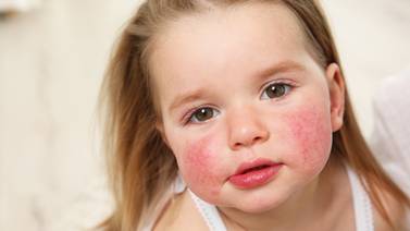 Irritaciones en la piel afectan las amistades de quienes sufren dermatitis atópica