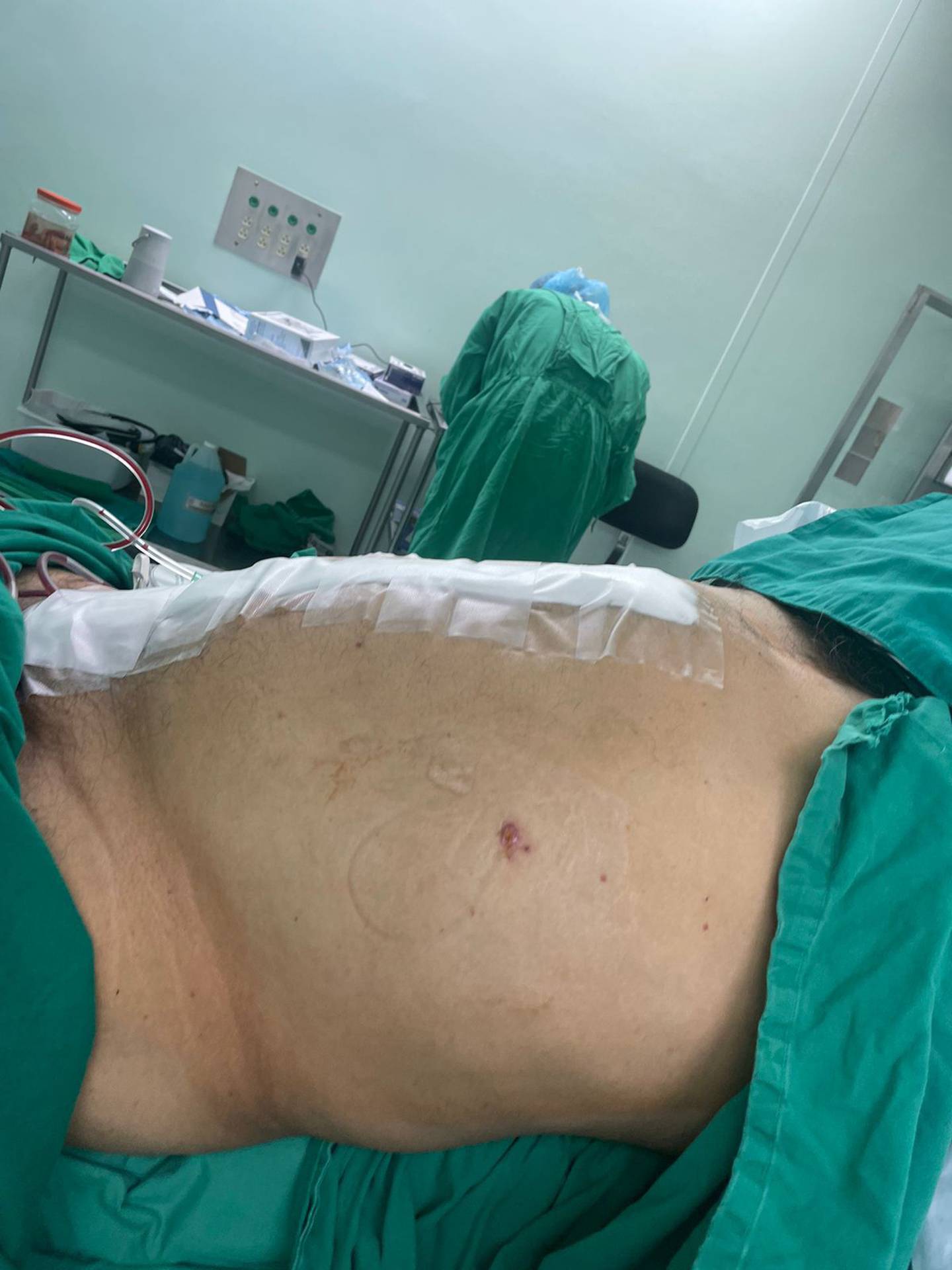 A un paciente de Cañas del hospital Enrique Baltodano Briceño de Liberia le sacaron una hernia tremendamente gigante el pasado viernes 6 e octubre