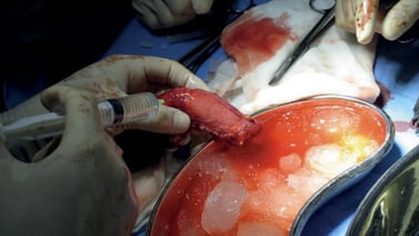 Transplante de pene es todo un éxito, confirma primer hombre que pasó por el procedimiento
