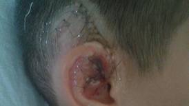 Accidente en escuela alajuelense casi le cuesta la oreja a un niño de 12 años