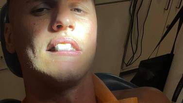 ¡Quedó chimuelo! Futbolista pierde tres dientes al intentar cabecear la pelota frente a un rival