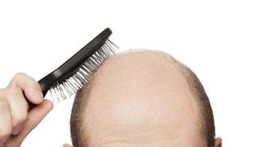 Calvos se llenan de esperanza con nuevo estudio para evitar caída del cabello