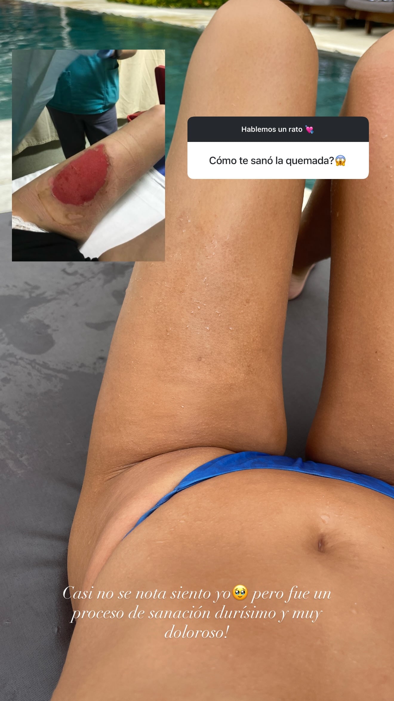 La cantante Fátima Pinto mostró en las últimas horas cómo quedó su pierna izquierda tras la seria quemadura que sufrió hace seis años por la explosión de una cocina de gas.