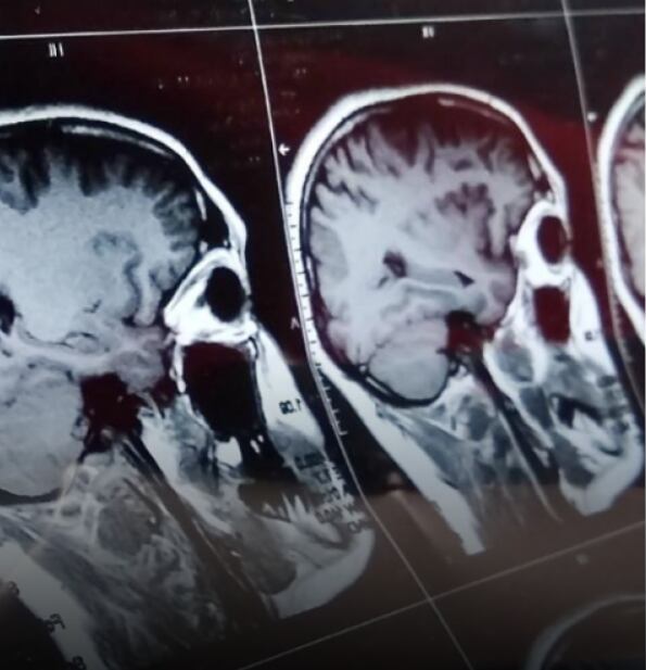 Mujer con cáncer cerebral