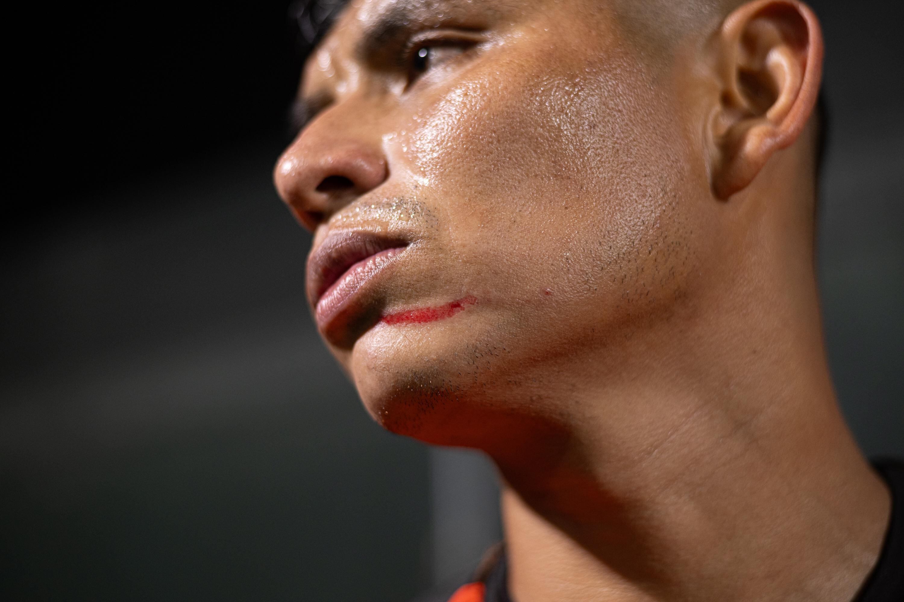 Miguel Sansores y los pellizcos que le dieron los jugadores de Alajuelense