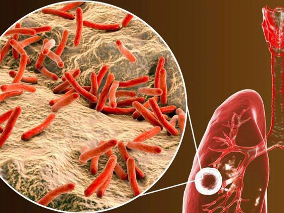 El Ministerio de Salud tiene un plan para erradicar la tuberculosis para el 2035. Foto: Shutterstock.