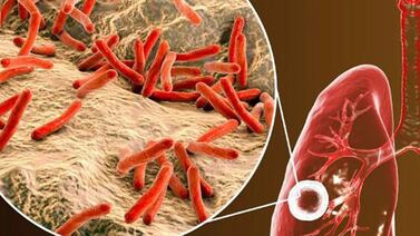 Esta es la enfermedad que más de un millón de ticos tienen y ni saben