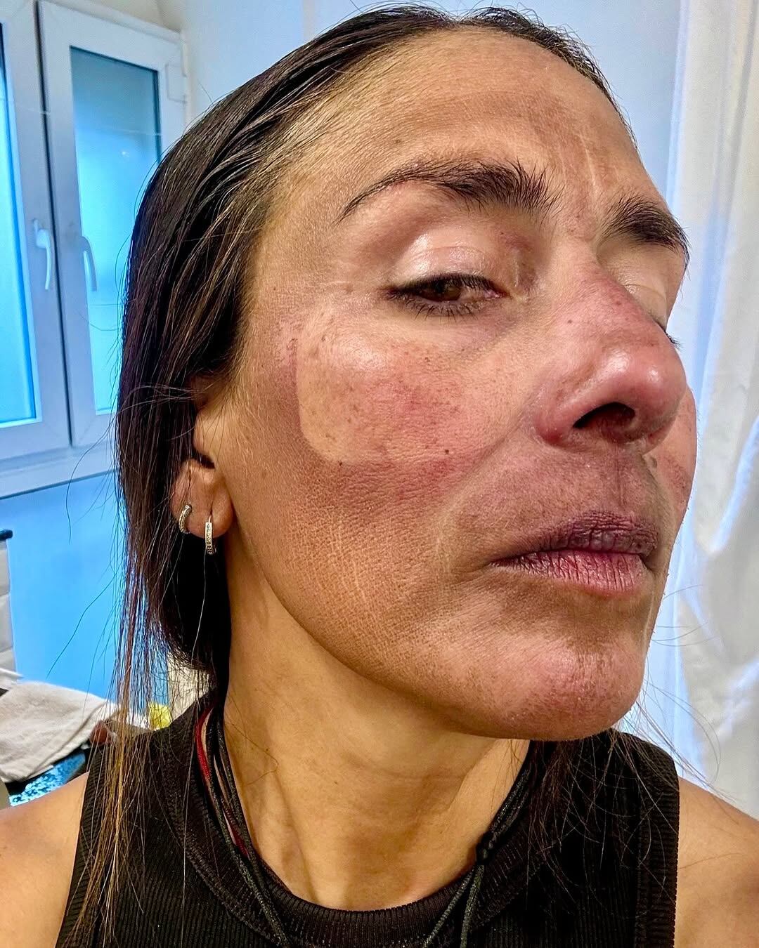 Así lucía Ligia Madrigal luego de subir el Everest.