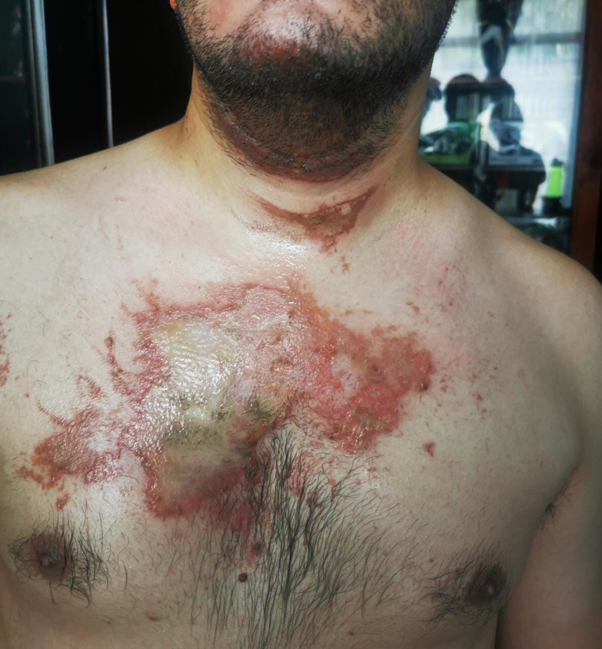 Diseñador gráfico denuncia que explosión de computadora le causó graves quemaduras. Foto cortesía. Frank Murcia.