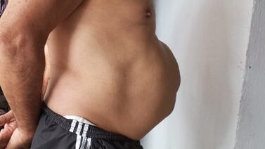 Señor está desesperado porque lleva 7 años esperando una cirugía para quitarle una hernia