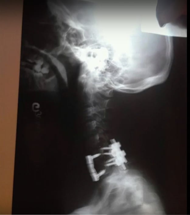 Alejandra Villalta Roldán fue la última paraatleta que ingresó a la meta en la carrera La Candelaria del pasado domingo 9 de febrero, sin embargo, se ganó la medalla de oro al esfuerzo, la perseverancia, el amor al deporte y la inspiración