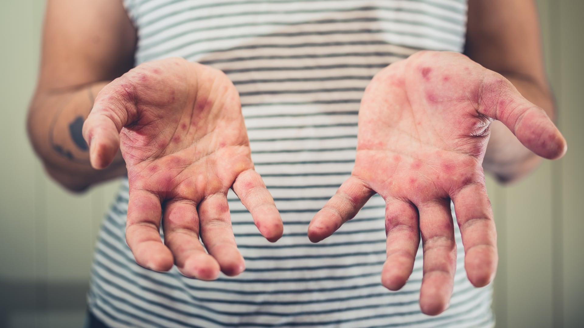 El repunte del sarampión deja miles de contagios y decenas de miles de muertes en el mundo, según alertas de la Red Mundial de Virus y la OMS.