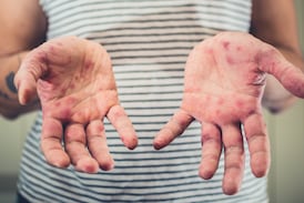 Ministerio de Salud confirma caso de sarampión en Costa Rica, el paciente y el lugar