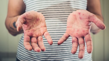 Ministerio de Salud confirma caso de sarampión en Costa Rica, el paciente y el lugar