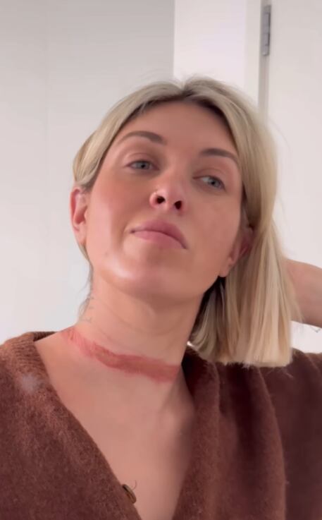 Así quedó su cuello tras el accidente.