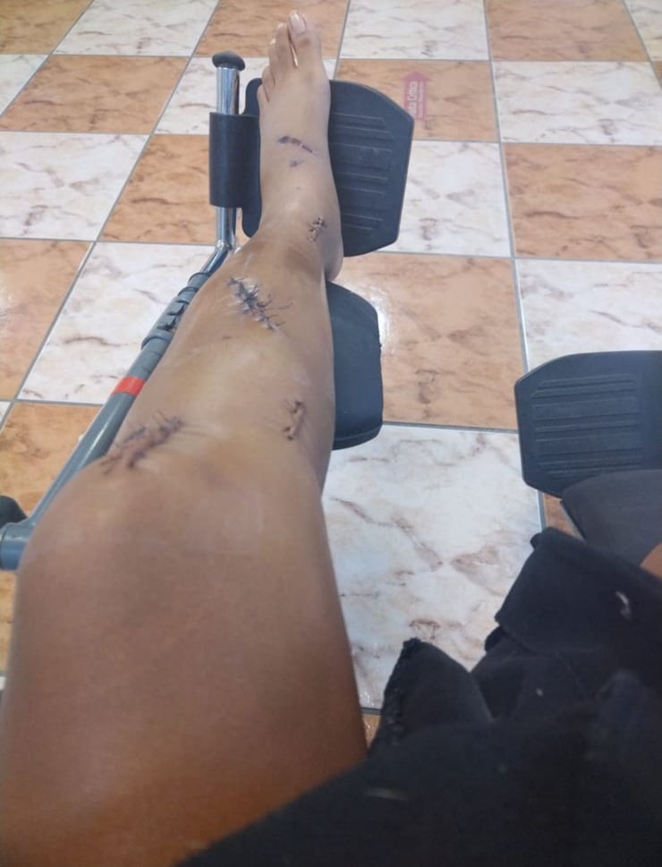 El jugador Randy Ramírez, del Municipal Liberia estaría involucrado en un accidente de tránsito, que provocó serias lesiones a una joven de 20 años. Cortesía.