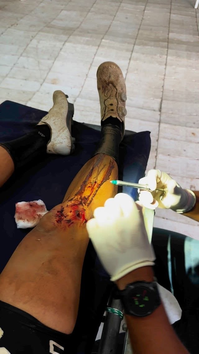 Johanna Solano sufrió un accidente en Sudáfrica este miércoles mientras disputaba la tercera etapa de la The Untamed African MTB Race, una de las competencias de ciclismo de montaña más famosas del mundo.