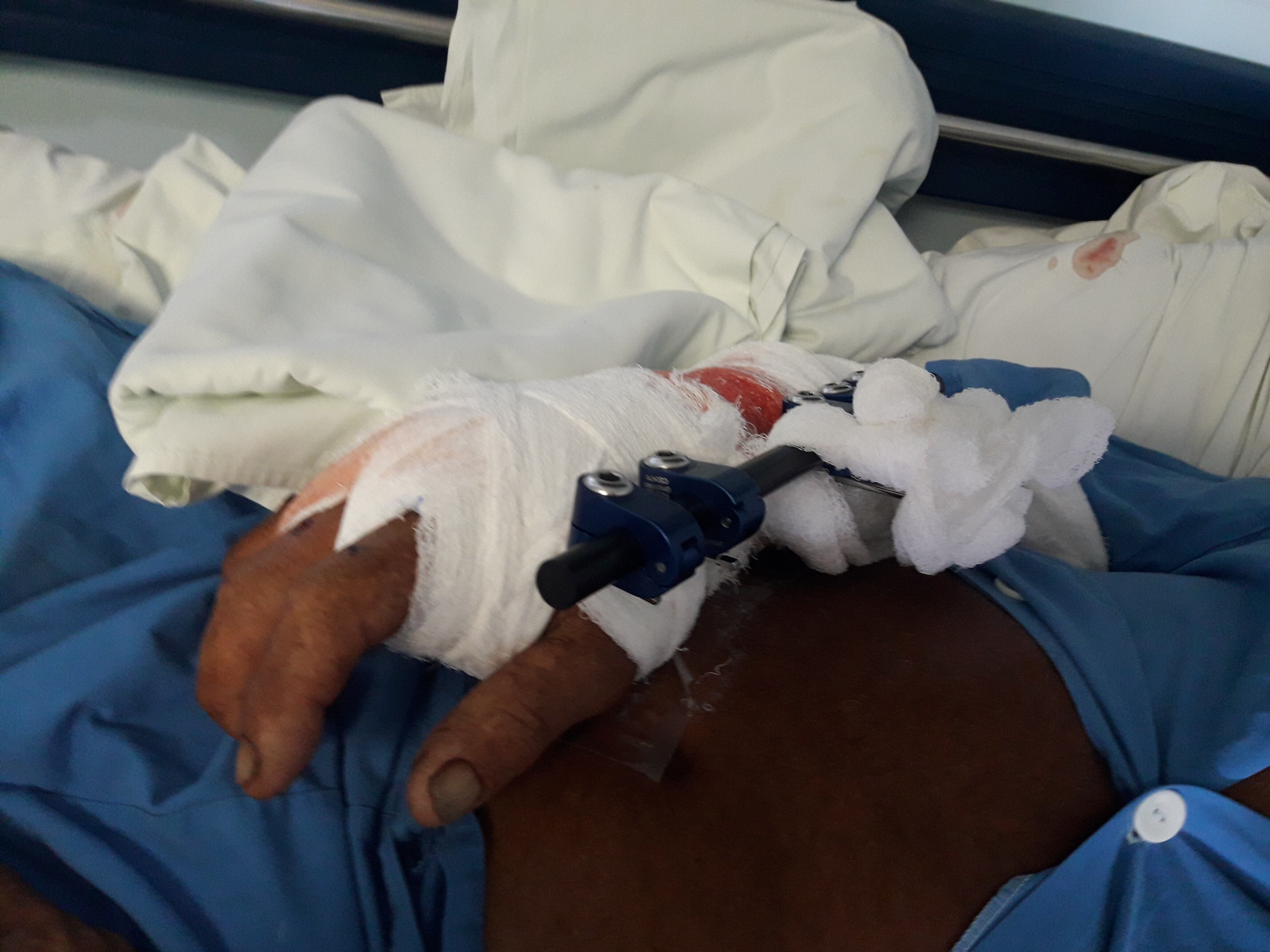 Anselmo Cortés, hombre que sobrevivió a ataque de cocodrilo en Osa. Foto Alfonso Quesada.