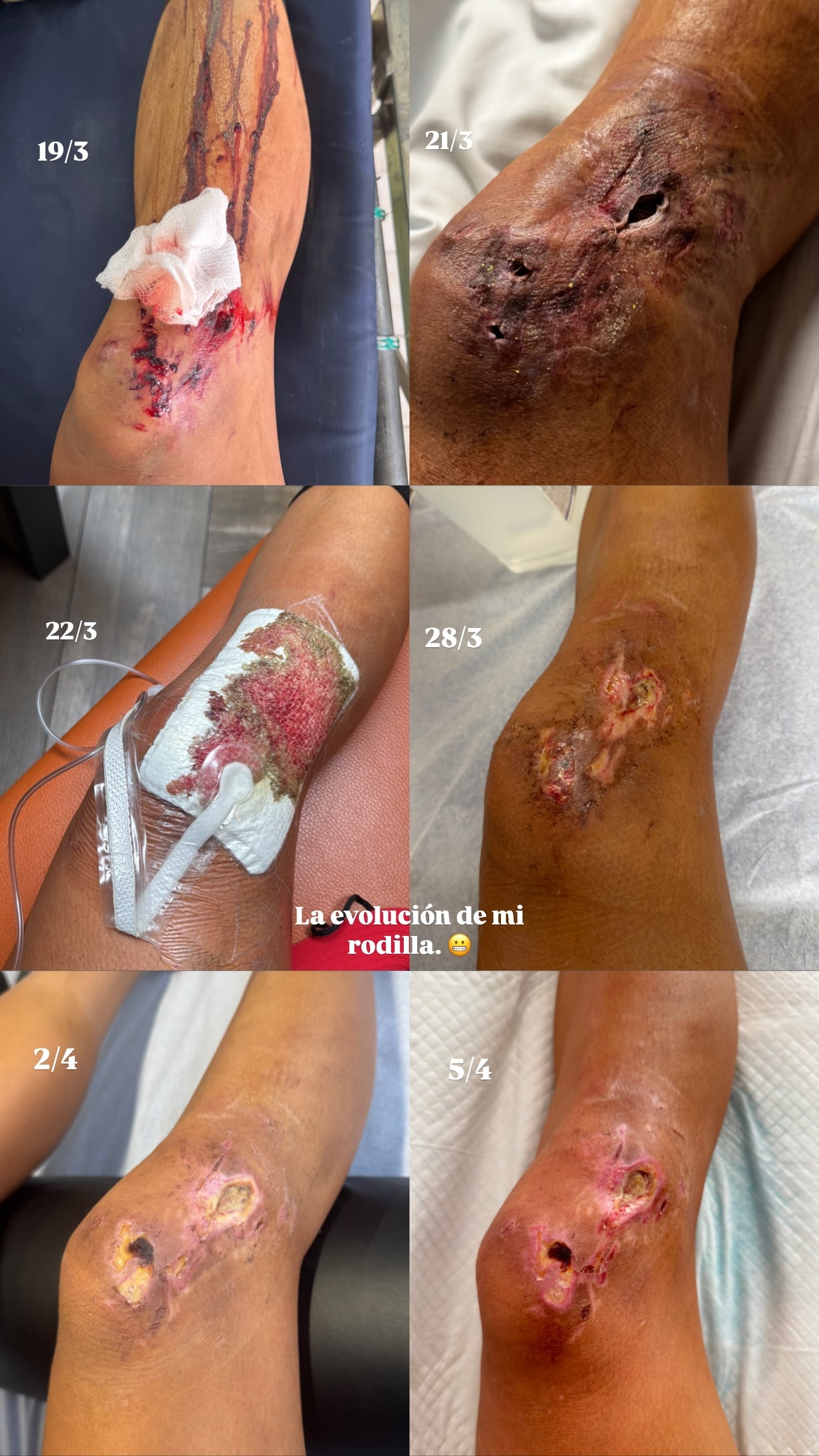 Johanna Solano publica impactantes fotos de su progreso tras accidente en Sudáfrica