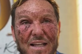 Eric Rojas mostró finalmente cómo quedó su rostro tras el procedimiento que lo dejó irreconocible