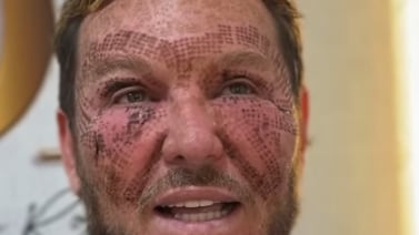Doctor Eric Rojas cuenta cómo su hijo terminó dejándole el rostro en estas condiciones