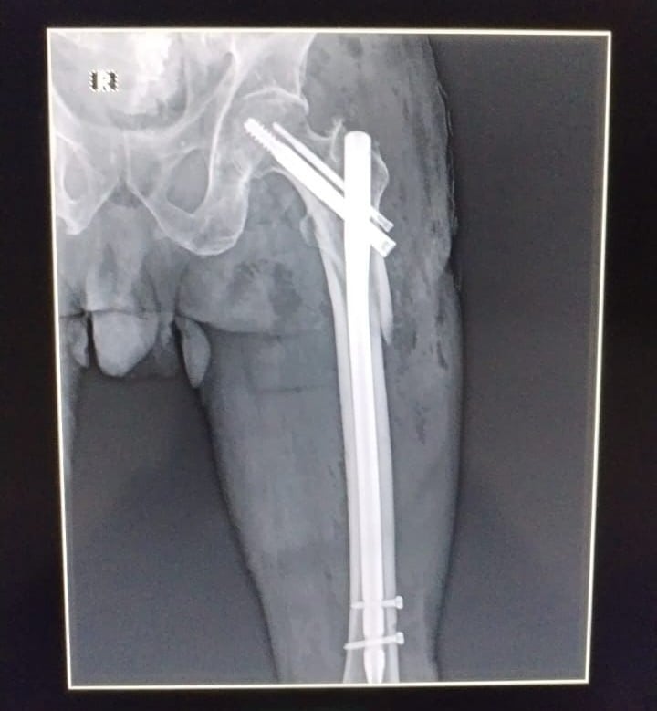 Hospital de San Vito logró hacer por primera vez una operación de cadera.