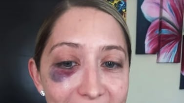 ¿Cómo sigue Lucía Jiménez del golpe en el ojo y contra qué pegó? Ella misma nos contó si podrá ensayar