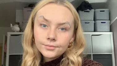 Mujer sufre rara enfermedad y debe pegarse los párpados con cinta adhesiva para poder ver