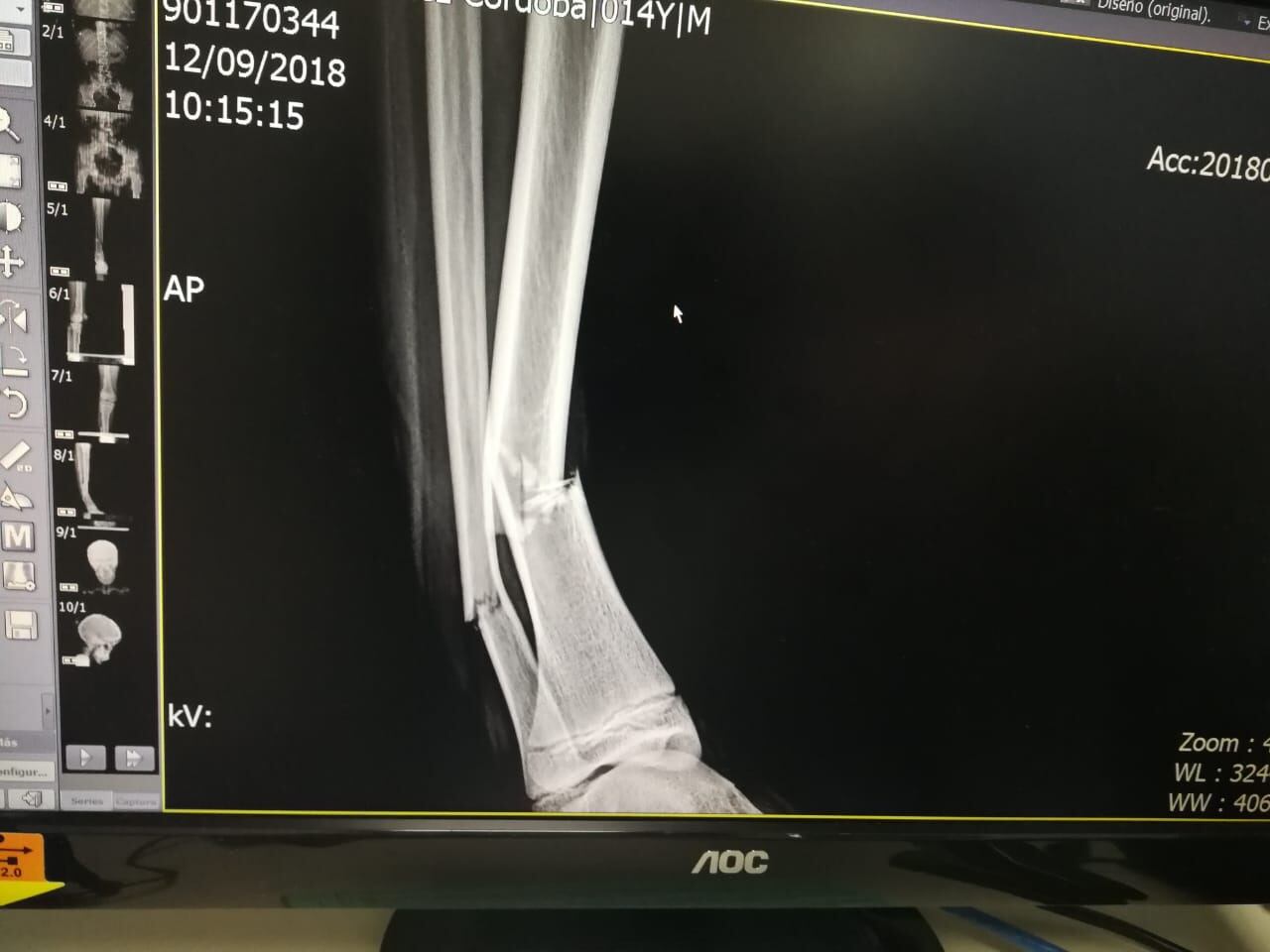 Deyton Hernández, joven que sobrevivió a atropello ocurrido en setiembre del 2018. Foto cortesía Alexandra Córdoba.