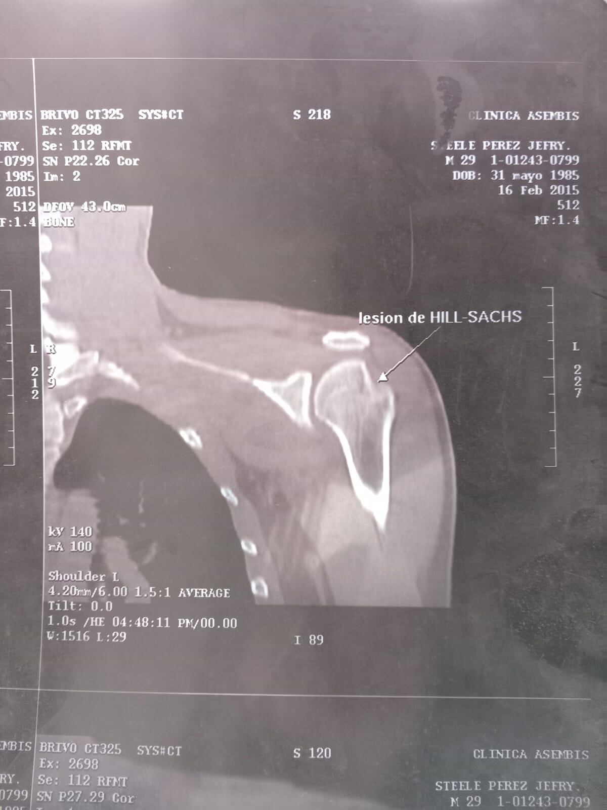 El artista nacional Young Steele vive un calvario desde hace 10 años, luego de un accidente. Necesita una operación en su hombro y en la CCSS no resuelven.