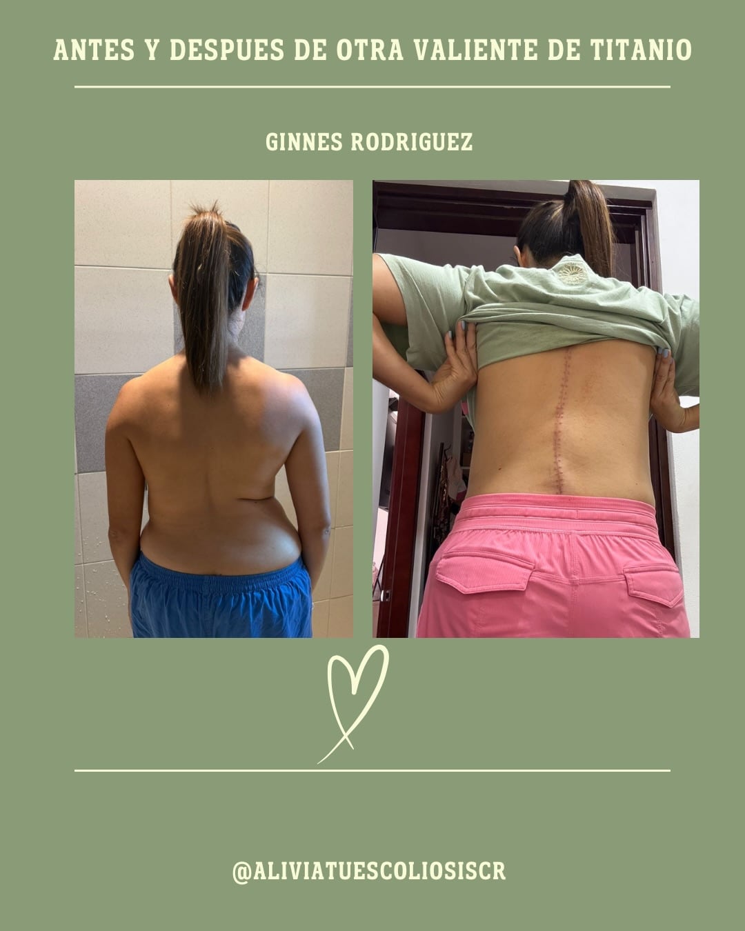 Ginés Rodríguez con su antes y después de la operación de columna.