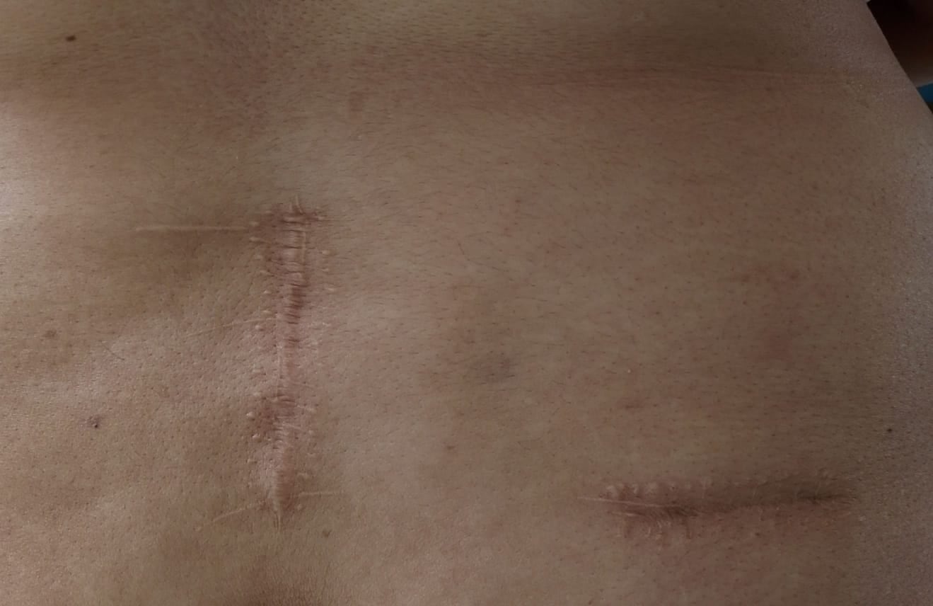 Karen nos comparte las cicatrices de las cirugías que le cambiaron la vida. Foto: Cortesía.