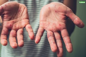 Ministerio de Salud confirma cuarto caso de sarampión en esta parte de Costa Rica