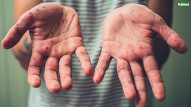 Ministerio de Salud confirma cuarto caso de sarampión en esta parte de Costa Rica