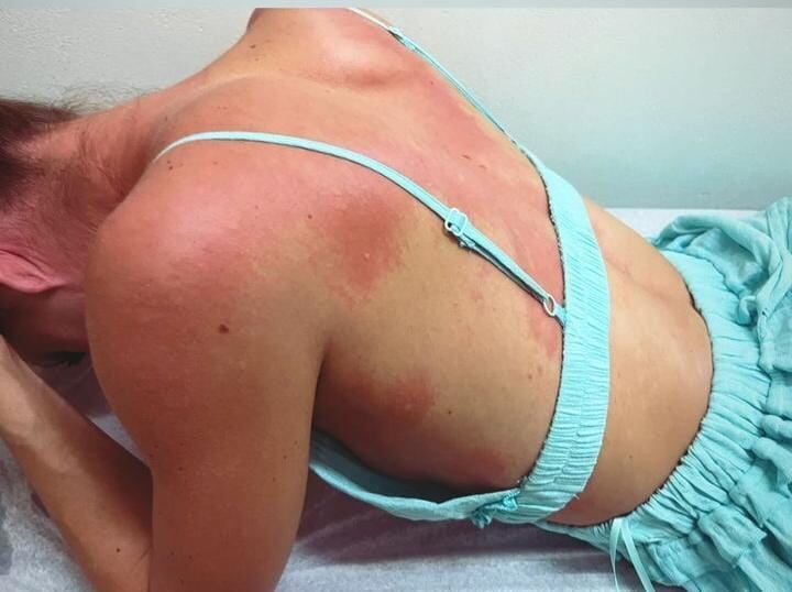 Así quedó Lisbeth Valverde tras picada por avispas barú