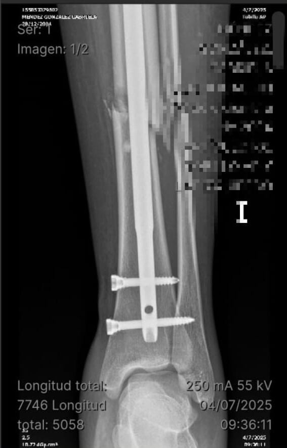 El jugador Randy Ramírez, del Municipal Liberia estaría involucrado en un accidente de tránsito, que provocó serias lesiones a una joven de 20 años. Cortesía.