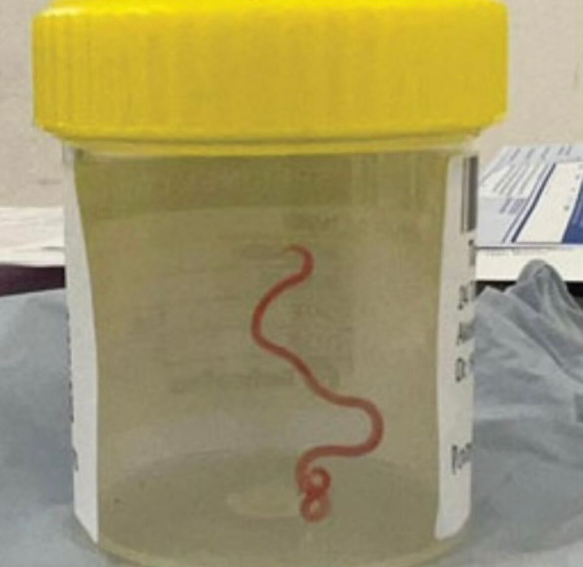 Mujer con lombriz intestinal