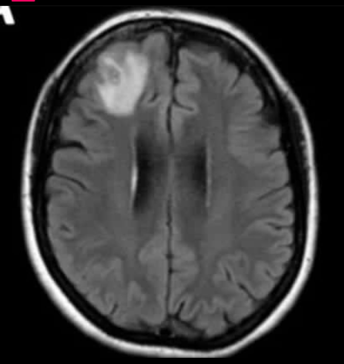 Lombriz en cerebro de una mujer