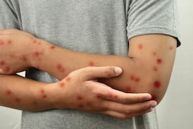 ¿Va a viajar? Esto recomienda Salud ante el aumento del sarampión en América