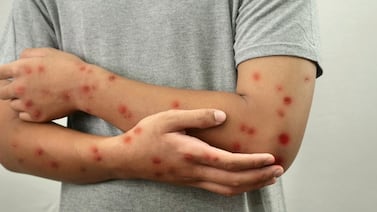 ¿Va a viajar? Esto recomienda Salud ante el aumento del sarampión en América