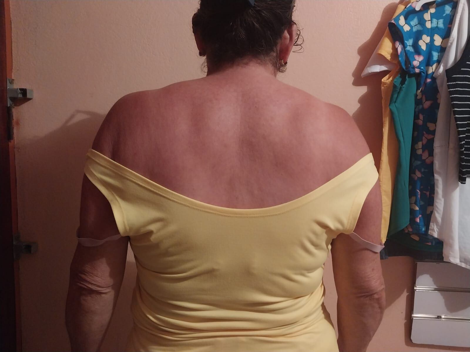 Desde agosto de 2017 la asegurada Vera ALpízar está a la espera de una cirugía de columna.