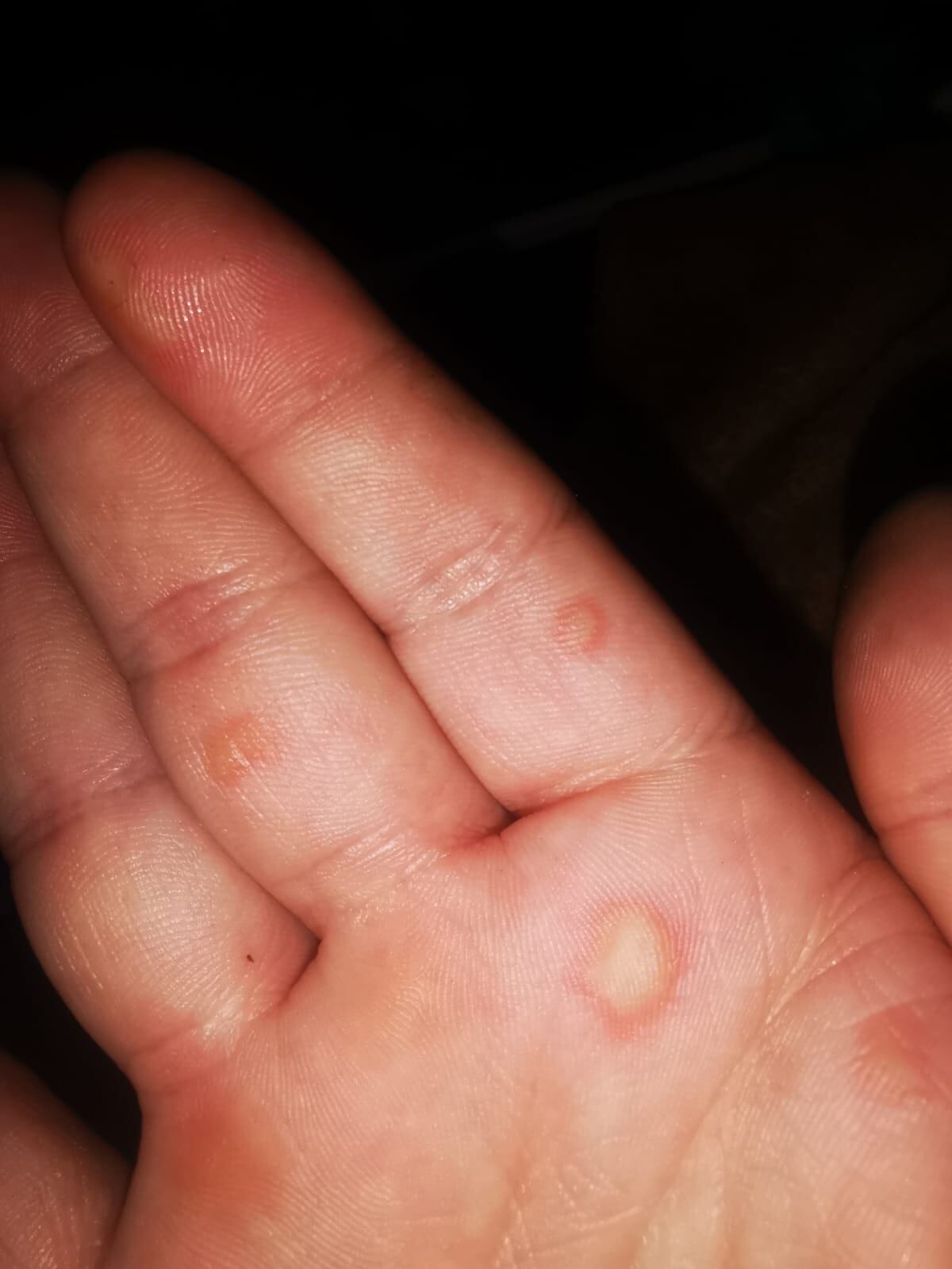 Diseñador gráfico denuncia que explosión de computadora le causó graves quemaduras. Foto cortesía. Frank Murcia.