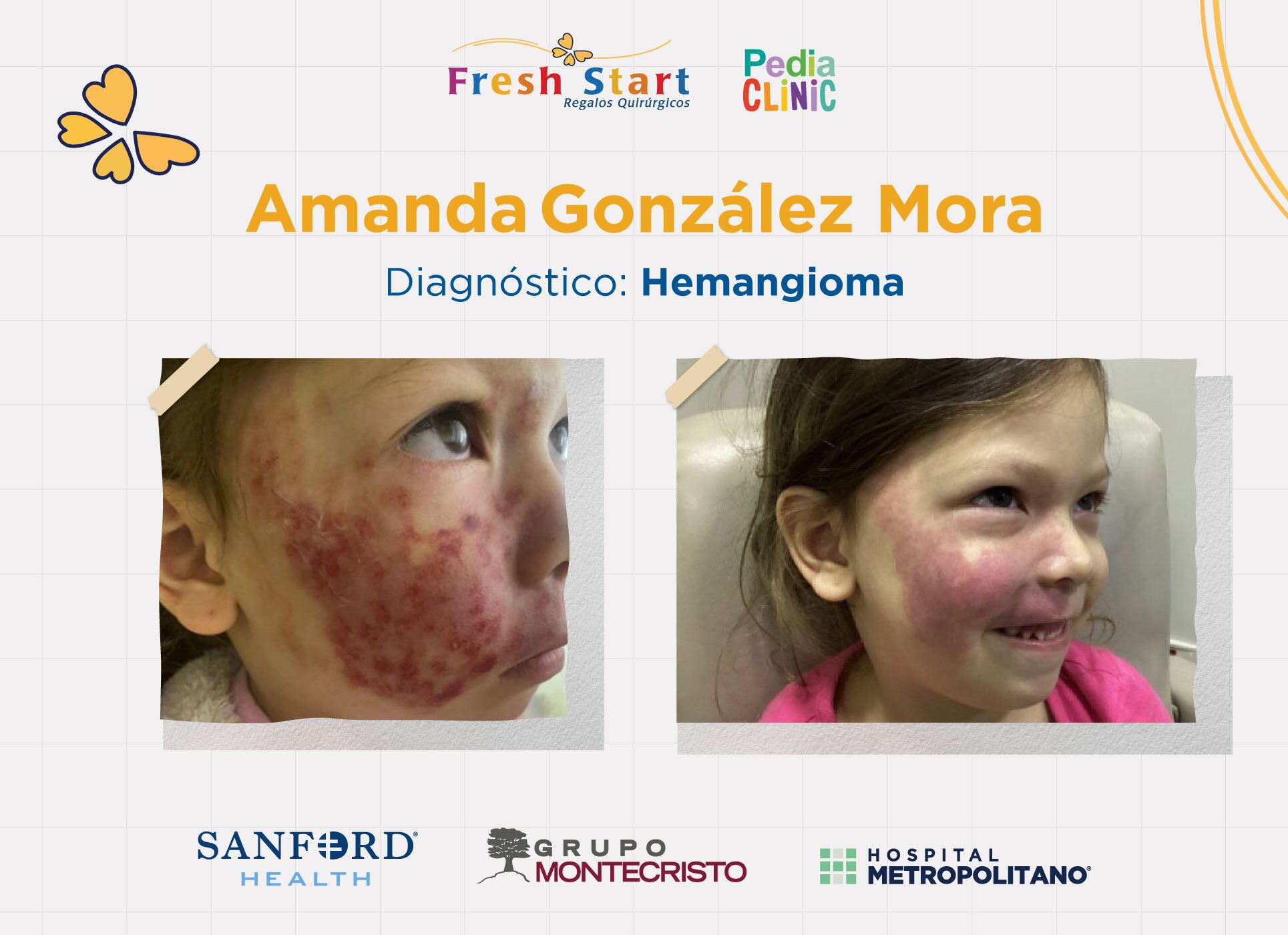 Buscando darle una oportunidad a estos niños y jóvenes la Fundación Fresh Start en unión con el Hospital Metropolitano, PediaClinic y Sanford Health, anuncia el regreso de un programa que permitirá que más niños costarricenses puedan acceder a cirugías reconstructivas gratuitas en Estados Unidos.