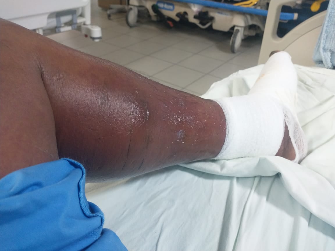 Don Danilo Quintanilla, vecino de La Guaria de Bella Vista de Guápiles fue mordido en abril pasado por una terciopelo.