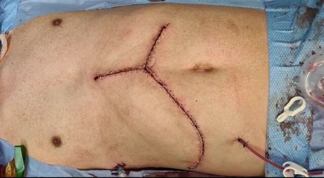 Especialistas del Hospital San Juan de Dios le quitaron un tumor bien grande a un joven, el cual se encontraba ubicado en el lado derecho del tórax y ponía en peligro órganos vitales como corazón, riñón, hígado y la vena cava inferior