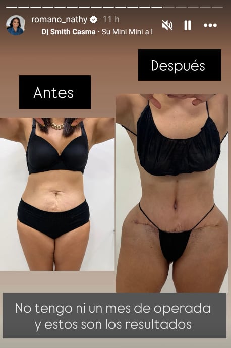 Natalia Romano, hermana de Choché Romano, mostró como va su recuperación y los resultados de su cirugía.